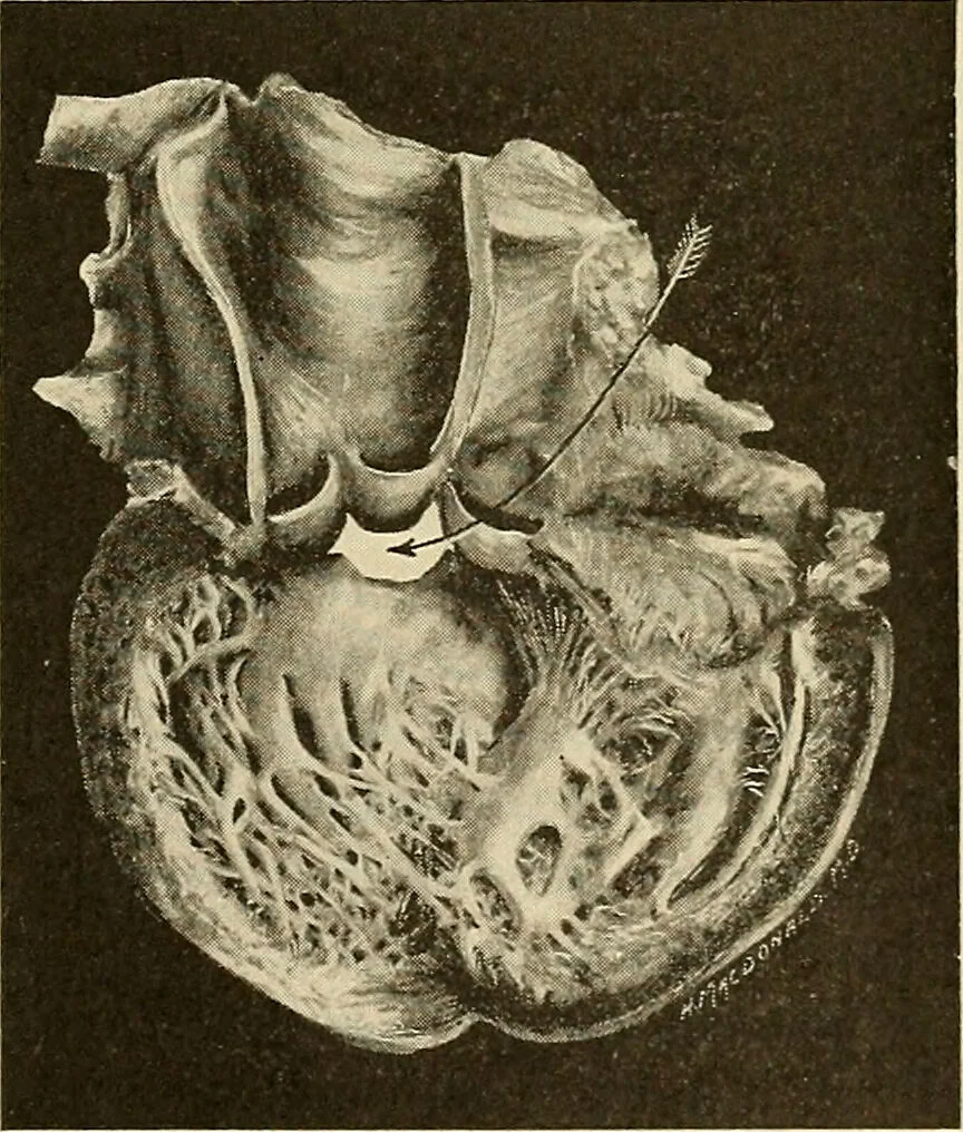 An illustration from The diseases of infancy and childhood : for the use of students and practitioners of medicine / by L. Emmett Holt with two hundred and forty-one illustrations, including eight coloured plates., 1908, leaf 653
