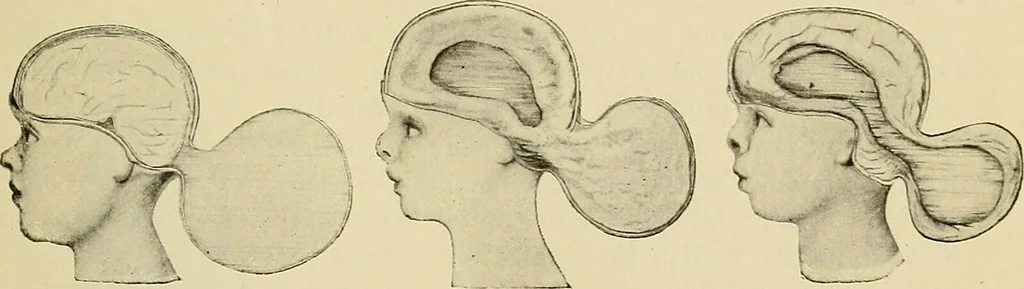 An illustration from The diseases of infancy and childhood : for the use of students and practitioners of medicine / by L. Emmett Holt with two hundred and forty-one illustrations, including eight coloured plates., 1908, leaf 789