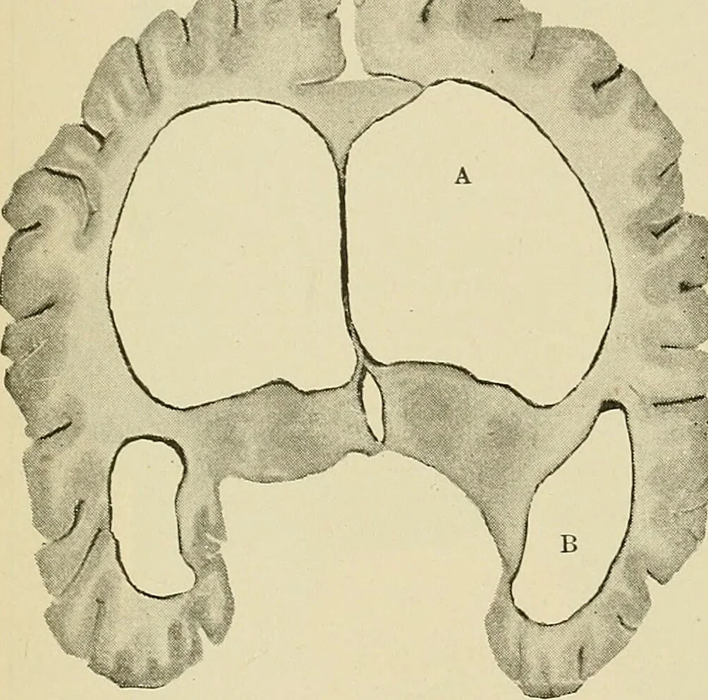 An illustration from The diseases of infancy and childhood : for the use of students and practitioners of medicine / by L. Emmett Holt with two hundred and forty-one illustrations, including eight coloured plates., 1908, leaf 835