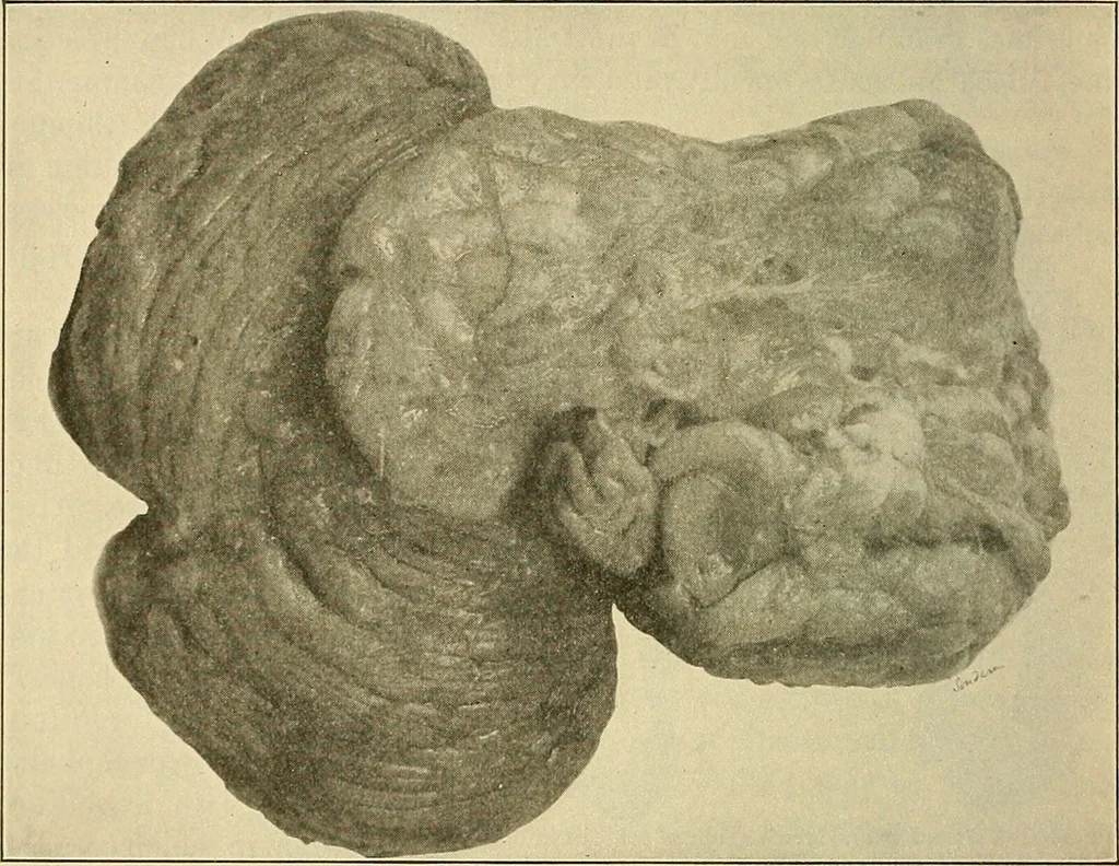 An illustration from The diseases of infancy and childhood : for the use of students and practitioners of medicine / by L. Emmett Holt with two hundred and forty-one illustrations, including eight coloured plates., 1908, leaf 836