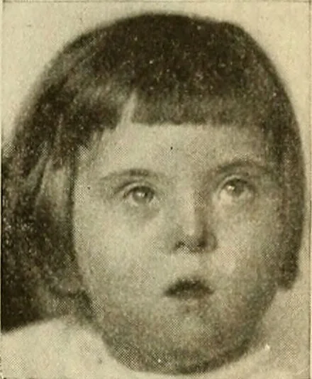 An illustration from The diseases of infancy and childhood : for the use of students and practitioners of medicine / by L. Emmett Holt with two hundred and forty-one illustrations, including eight coloured plates., 1908, leaf 849
