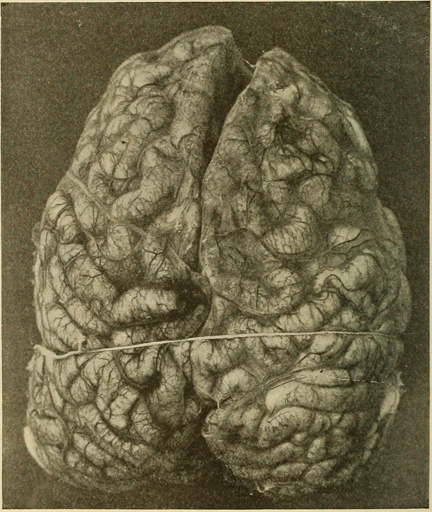 An illustration from The diseases of infancy and childhood : for the use of students and practitioners of medicine / by L. Emmett Holt with two hundred and forty-one illustrations, including eight coloured plates., 1908, leaf 850