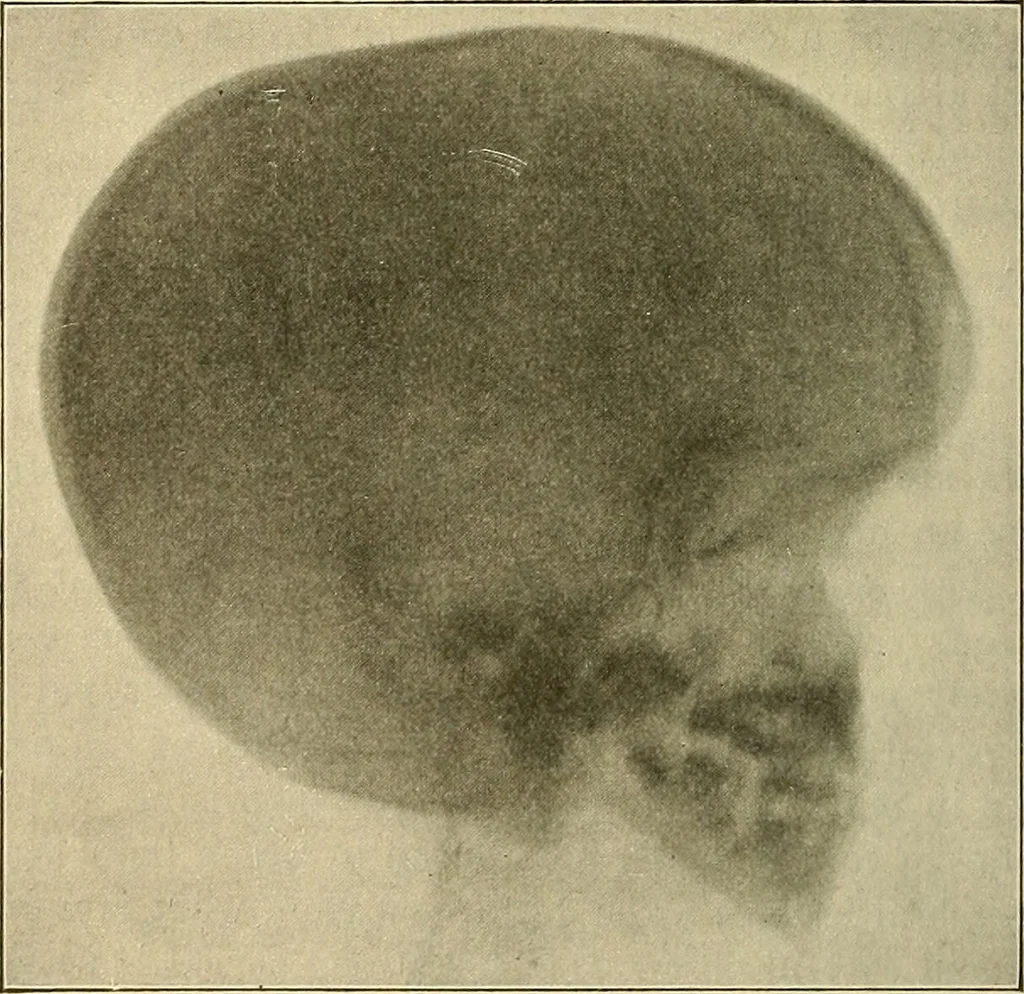 An illustration from The diseases of infancy and childhood : for the use of students and practitioners of medicine / by L. Emmett Holt with two hundred and forty-one illustrations, including eight coloured plates., 1908, leaf 854