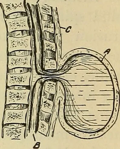 An illustration from The diseases of infancy and childhood : for the use of students and practitioners of medicine / by L. Emmett Holt with two hundred and forty-one illustrations, including eight coloured plates., 1908, leaf 866