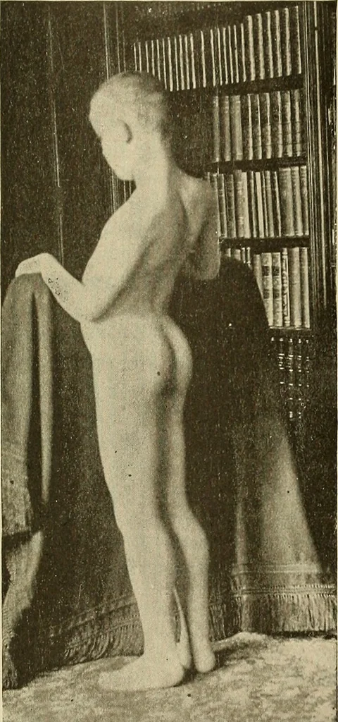 An illustration from The diseases of infancy and childhood : for the use of students and practitioners of medicine / by L. Emmett Holt with two hundred and forty-one illustrations, including eight coloured plates., 1908, leaf 889