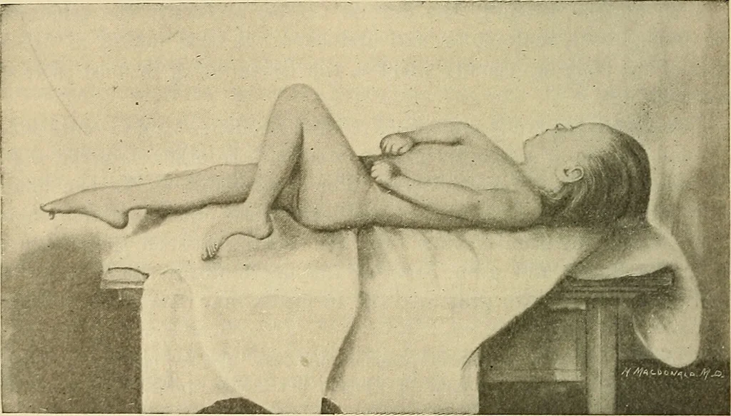 An illustration from The diseases of infancy and childhood : for the use of students and practitioners of medicine / by L. Emmett Holt with two hundred and forty-one illustrations, including eight coloured plates., 1908, leaf 892