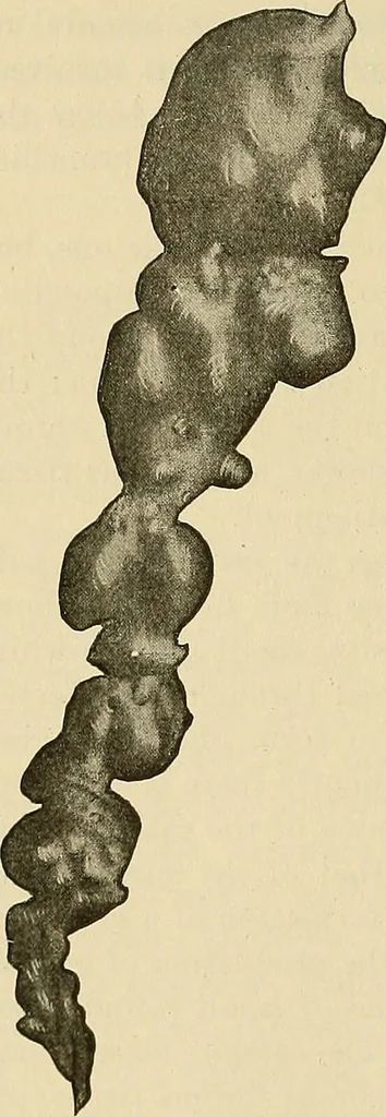 An illustration from The diseases of infancy and childhood : for the use of students and practitioners of medicine / by L. Emmett Holt with two hundred and forty-one illustrations, including eight coloured plates., 1908, leaf 936