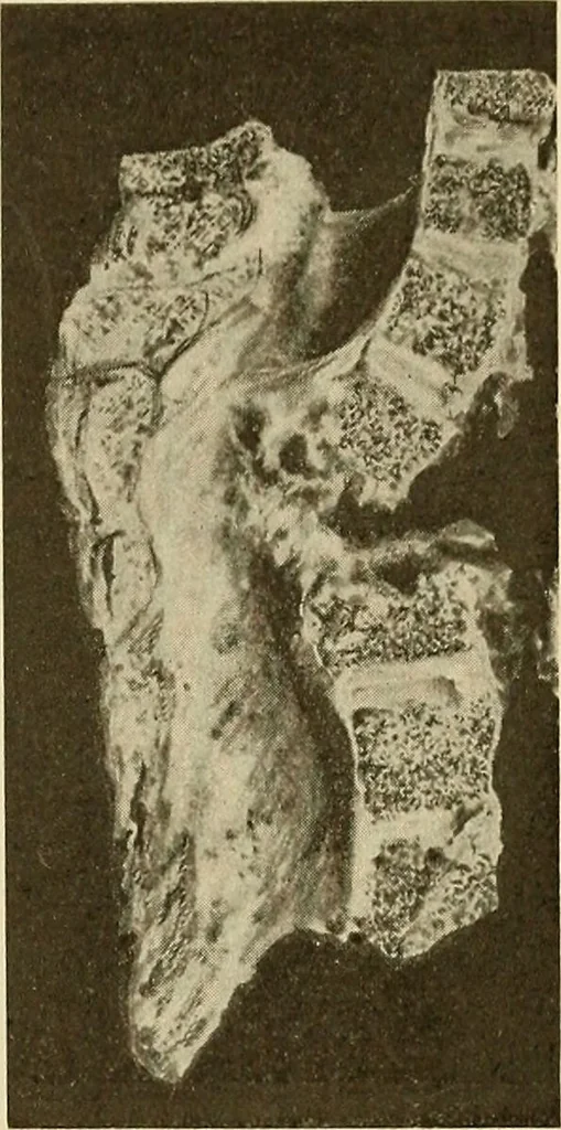 An illustration from The diseases of infancy and childhood : for the use of students and practitioners of medicine / by L. Emmett Holt with two hundred and forty-one illustrations, including eight coloured plates., 1908, leaf 949
