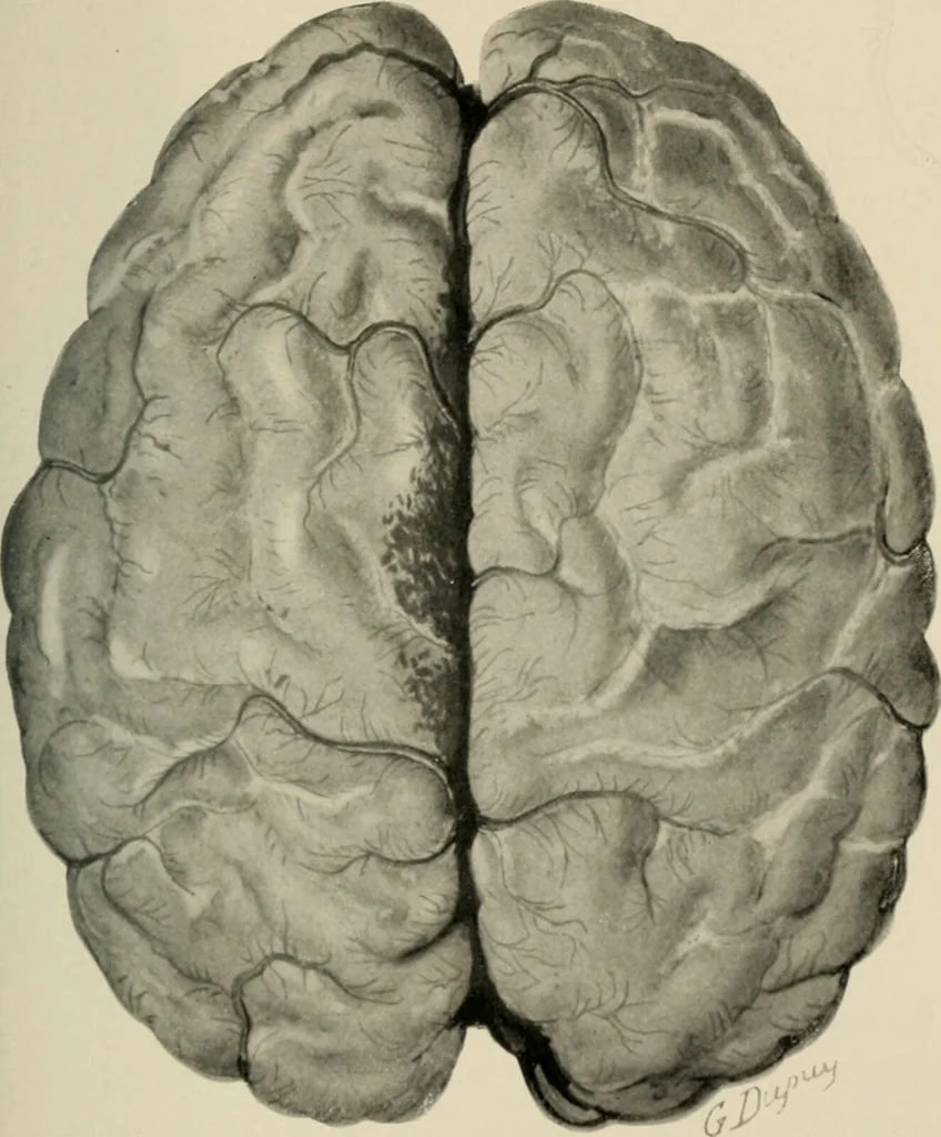 An illustration from Meningococcus meningitis / by Henry Heiman ... and Samuel Feldstein ... with introduction by Henry Koplik ... with 4 plates, 31 figures, 2 in color, and 4 charts., 1913, leaf 107