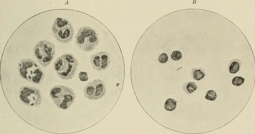 An illustration from Meningococcus meningitis / by Henry Heiman ... and Samuel Feldstein ... with introduction by Henry Koplik ... with 4 plates, 31 figures, 2 in color, and 4 charts., 1913, leaf 279