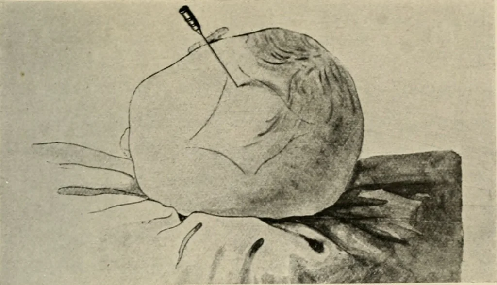 An illustration from Meningococcus meningitis / by Henry Heiman ... and Samuel Feldstein ... with introduction by Henry Koplik ... with 4 plates, 31 figures, 2 in color, and 4 charts., 1913, leaf 329