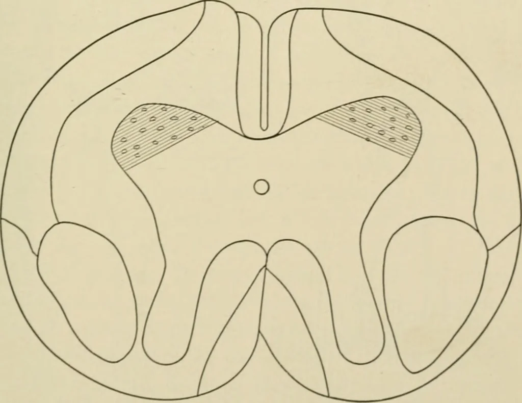 An illustration from Practical diagnosis: the use of symptoms in the diagnosis of disease / By Hobart Amory Hare ... Illustrated with 191 engravings and 13 colored plates., 1896, leaf 101