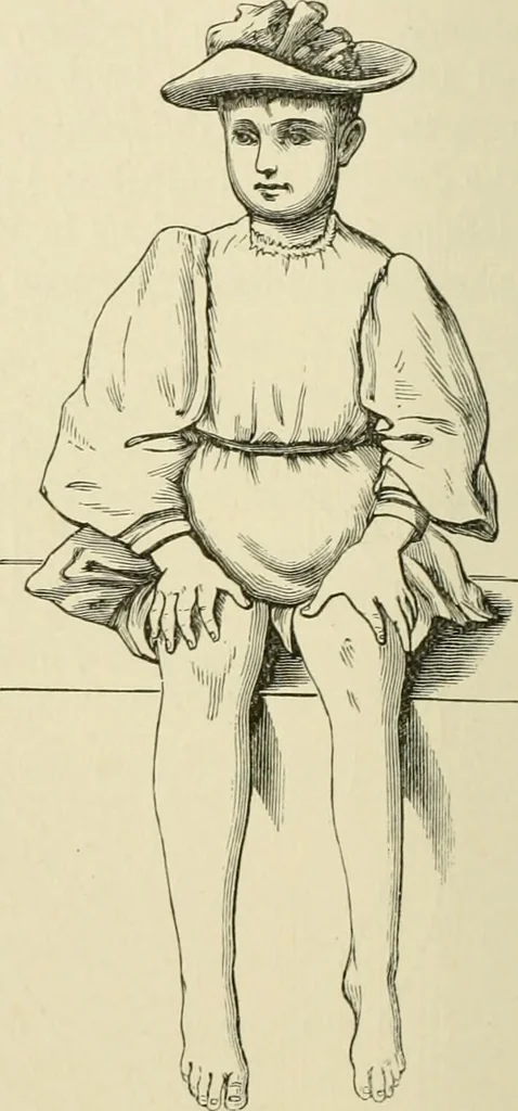 An illustration from Practical diagnosis: the use of symptoms in the diagnosis of disease / By Hobart Amory Hare ... Illustrated with 191 engravings and 13 colored plates., 1896, leaf 102