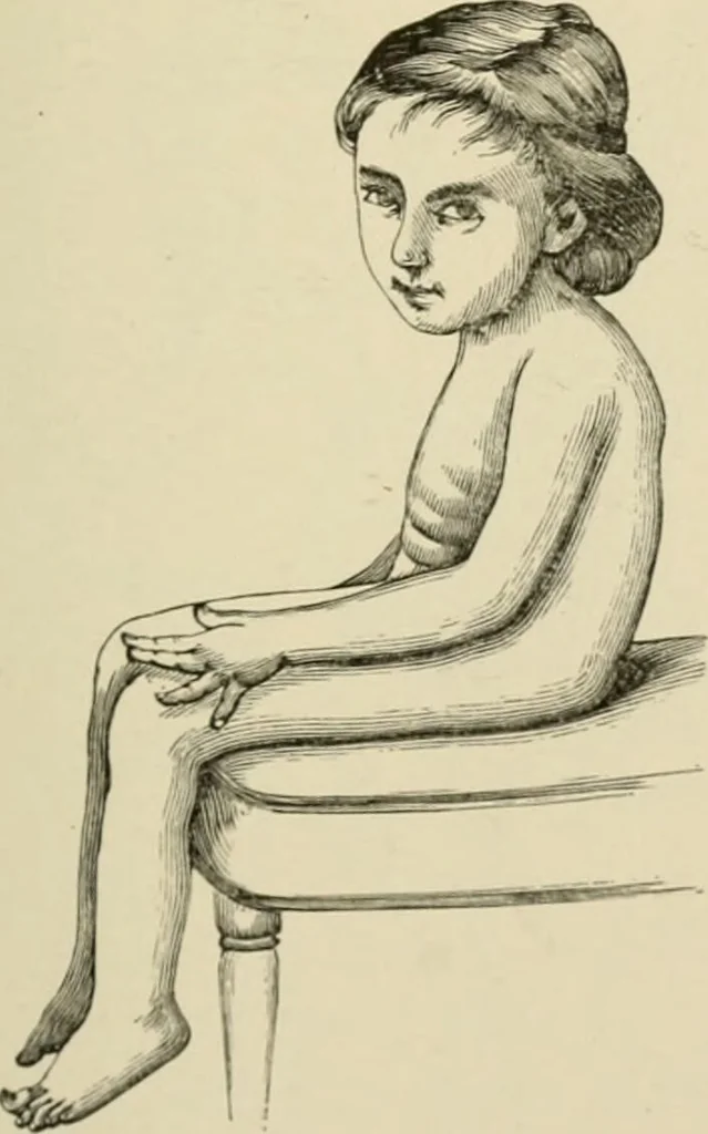 An illustration from Practical diagnosis: the use of symptoms in the diagnosis of disease / By Hobart Amory Hare ... Illustrated with 191 engravings and 13 colored plates., 1896, leaf 105