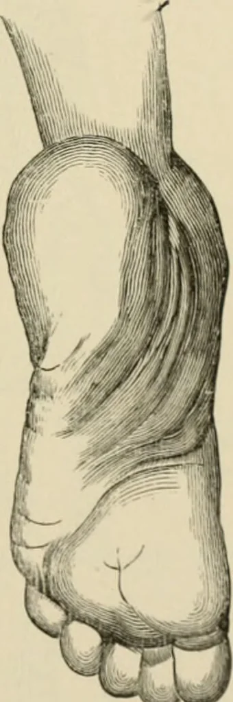 An illustration from Practical diagnosis: the use of symptoms in the diagnosis of disease / By Hobart Amory Hare ... Illustrated with 191 engravings and 13 colored plates., 1896, leaf 105