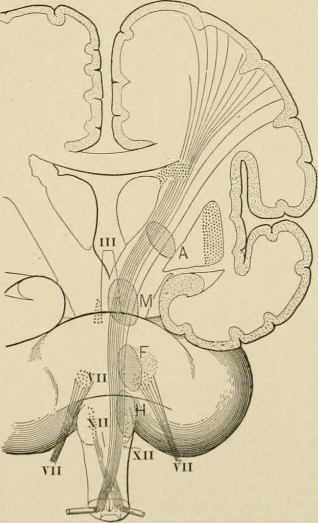 An illustration from Practical diagnosis: the use of symptoms in the diagnosis of disease / By Hobart Amory Hare ... Illustrated with 191 engravings and 13 colored plates., 1896, leaf 123