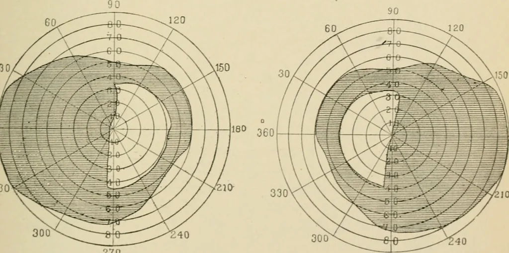 An illustration from Practical diagnosis: the use of symptoms in the diagnosis of disease / By Hobart Amory Hare ... Illustrated with 191 engravings and 13 colored plates., 1896, leaf 177