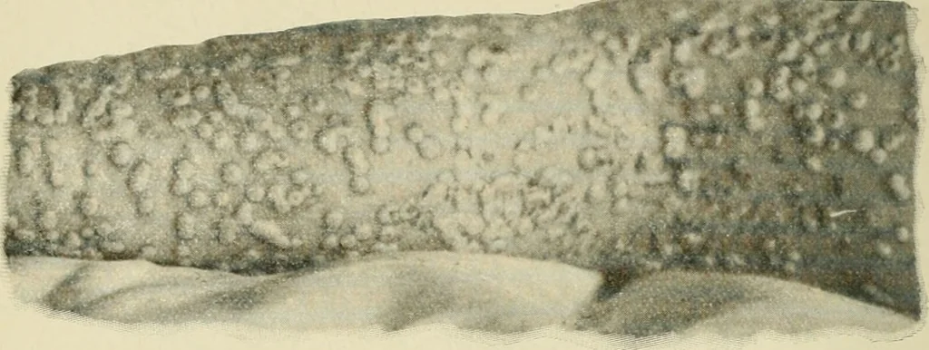 An illustration from Practical diagnosis: the use of symptoms in the diagnosis of disease / By Hobart Amory Hare ... Illustrated with 191 engravings and 13 colored plates., 1896, leaf 214