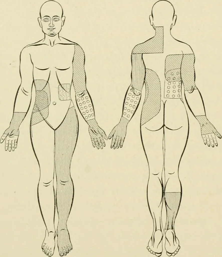 An illustration from Practical diagnosis: the use of symptoms in the diagnosis of disease / By Hobart Amory Hare ... Illustrated with 191 engravings and 13 colored plates., 1896, leaf 242