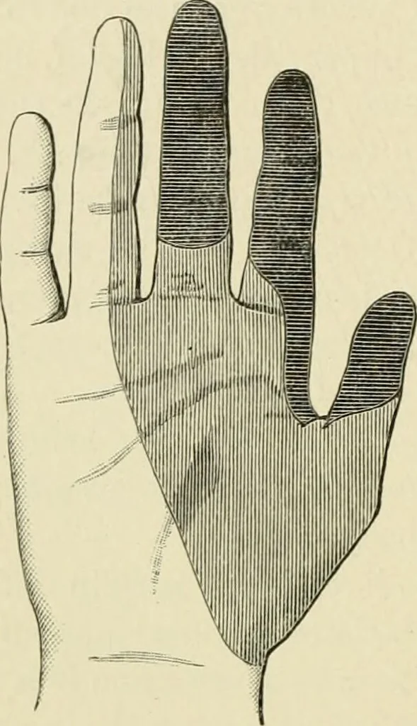 An illustration from Practical diagnosis: the use of symptoms in the diagnosis of disease / By Hobart Amory Hare ... Illustrated with 191 engravings and 13 colored plates., 1896, leaf 254