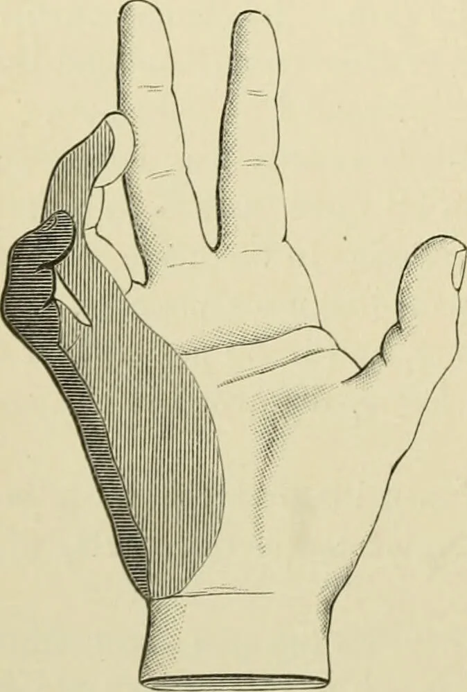 An illustration from Practical diagnosis: the use of symptoms in the diagnosis of disease / By Hobart Amory Hare ... Illustrated with 191 engravings and 13 colored plates., 1896, leaf 254