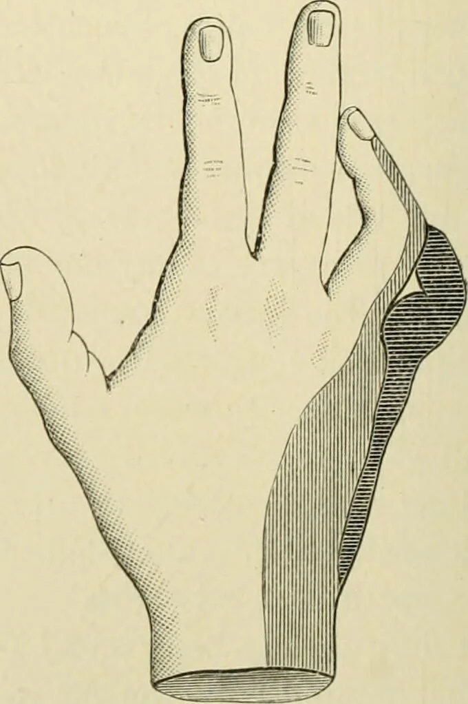 An illustration from Practical diagnosis: the use of symptoms in the diagnosis of disease / By Hobart Amory Hare ... Illustrated with 191 engravings and 13 colored plates., 1896, leaf 254