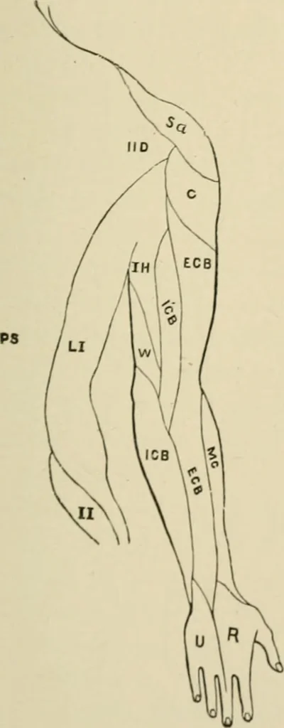 An illustration from Practical diagnosis: the use of symptoms in the diagnosis of disease / By Hobart Amory Hare ... Illustrated with 191 engravings and 13 colored plates., 1896, leaf 255