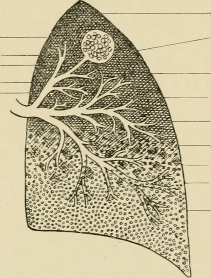 An illustration from Practical diagnosis: the use of symptoms in the diagnosis of disease / By Hobart Amory Hare ... Illustrated with 191 engravings and 13 colored plates., 1896, leaf 277