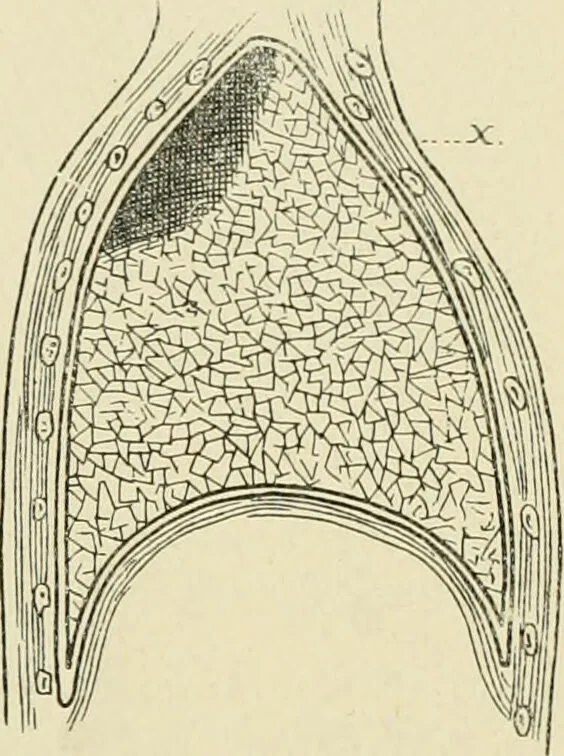 An illustration from Practical diagnosis: the use of symptoms in the diagnosis of disease / By Hobart Amory Hare ... Illustrated with 191 engravings and 13 colored plates., 1896, leaf 278