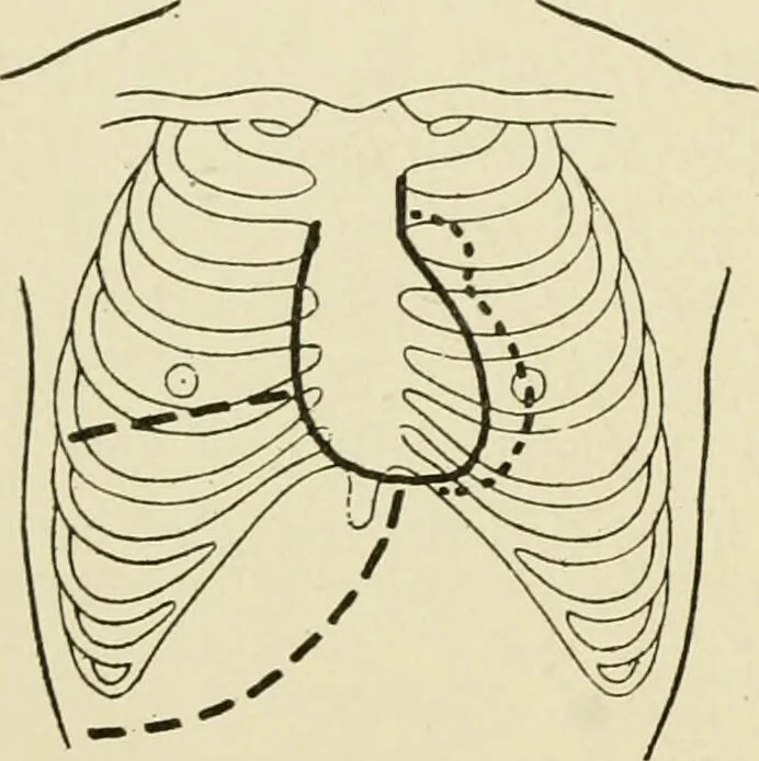 An illustration from Practical diagnosis: the use of symptoms in the diagnosis of disease / By Hobart Amory Hare ... Illustrated with 191 engravings and 13 colored plates., 1896, leaf 284