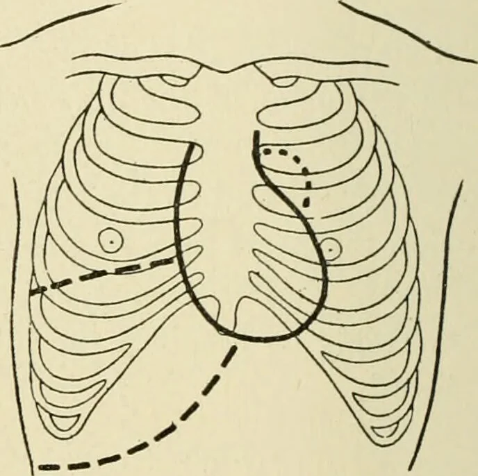 An illustration from Practical diagnosis: the use of symptoms in the diagnosis of disease / By Hobart Amory Hare ... Illustrated with 191 engravings and 13 colored plates., 1896, leaf 284