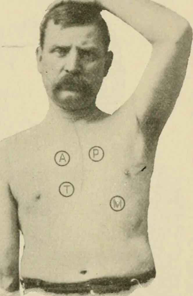 An illustration from Practical diagnosis: the use of symptoms in the diagnosis of disease / By Hobart Amory Hare ... Illustrated with 191 engravings and 13 colored plates., 1896, leaf 305