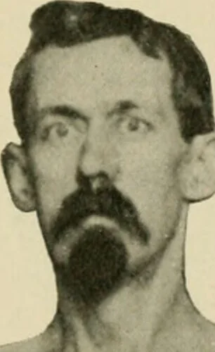 An illustration from Practical diagnosis: the use of symptoms in the diagnosis of disease / By Hobart Amory Hare ... Illustrated with 191 engravings and 13 colored plates., 1896, leaf 307