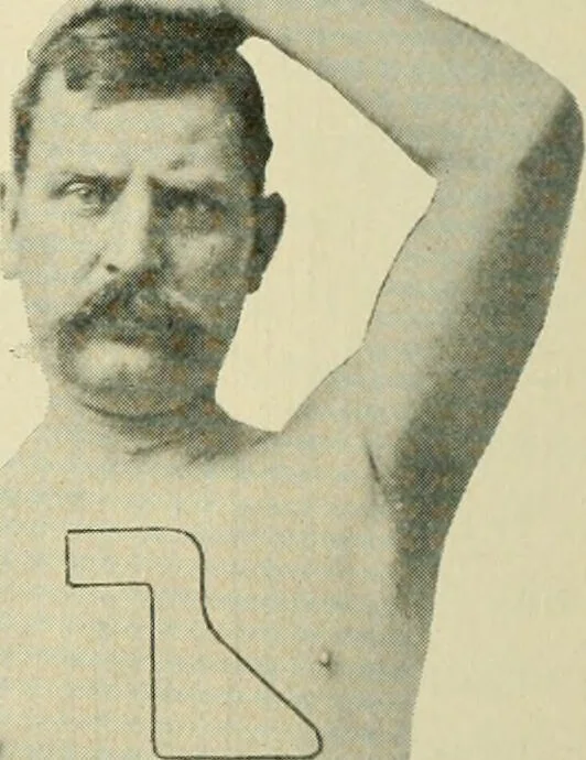 An illustration from Practical diagnosis: the use of symptoms in the diagnosis of disease / By Hobart Amory Hare ... Illustrated with 191 engravings and 13 colored plates., 1896, leaf 310