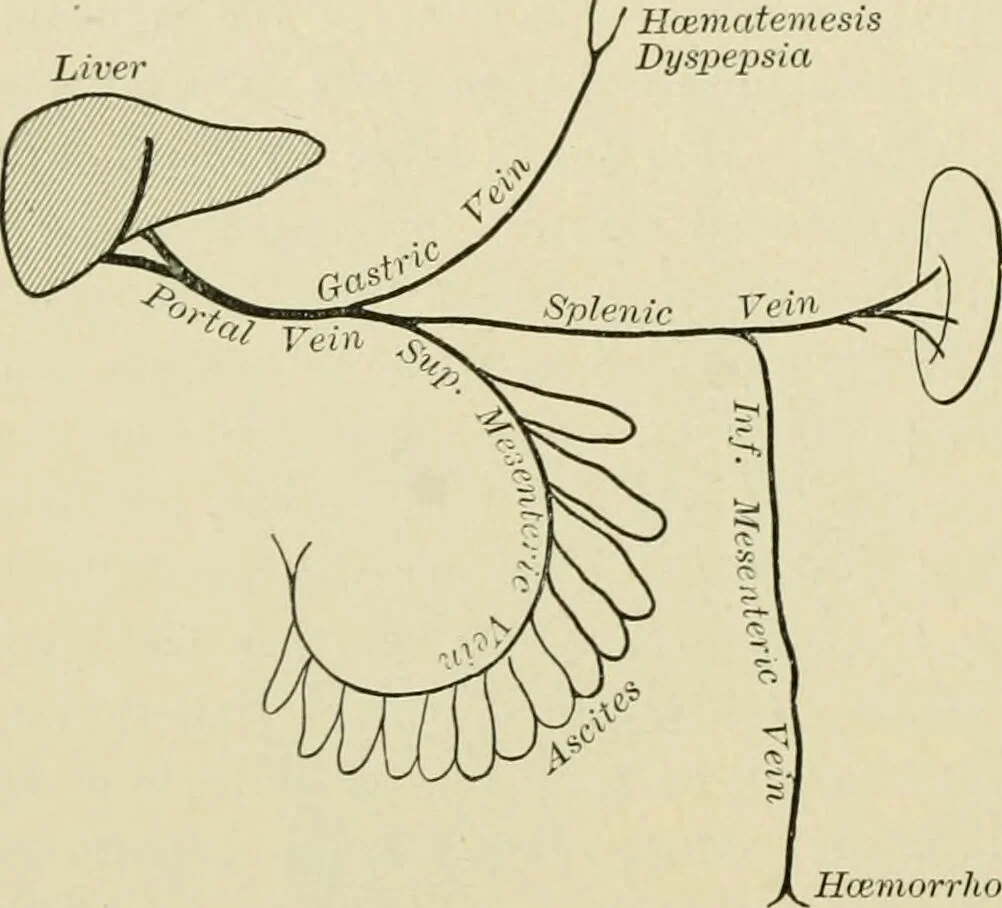 An illustration from Practical diagnosis: the use of symptoms in the diagnosis of disease / By Hobart Amory Hare ... Illustrated with 191 engravings and 13 colored plates., 1896, leaf 338