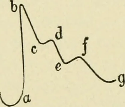 An illustration from Practical diagnosis: the use of symptoms in the diagnosis of disease / By Hobart Amory Hare ... Illustrated with 191 engravings and 13 colored plates., 1896, leaf 346