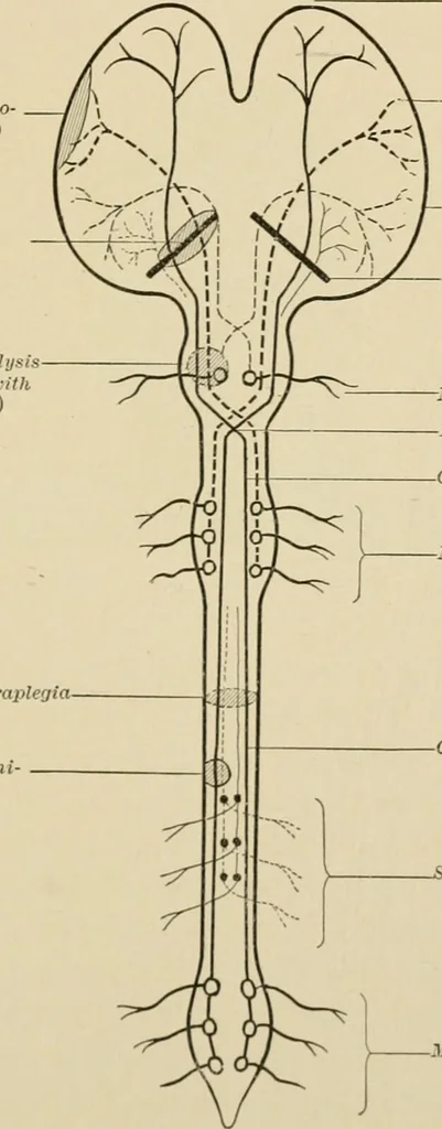 An illustration from Practical diagnosis: the use of symptoms in the diagnosis of disease / By Hobart Amory Hare ... Illustrated with 191 engravings and 13 colored plates., 1896, leaf 35
