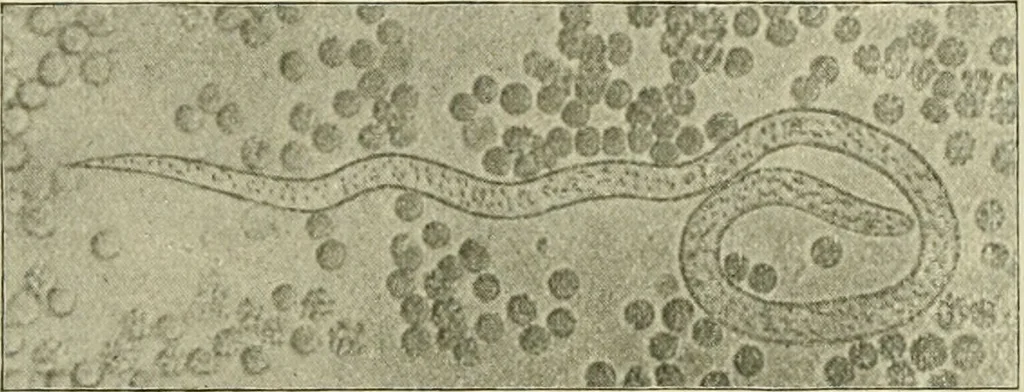 An illustration from Practical diagnosis: the use of symptoms in the diagnosis of disease / By Hobart Amory Hare ... Illustrated with 191 engravings and 13 colored plates., 1896, leaf 374