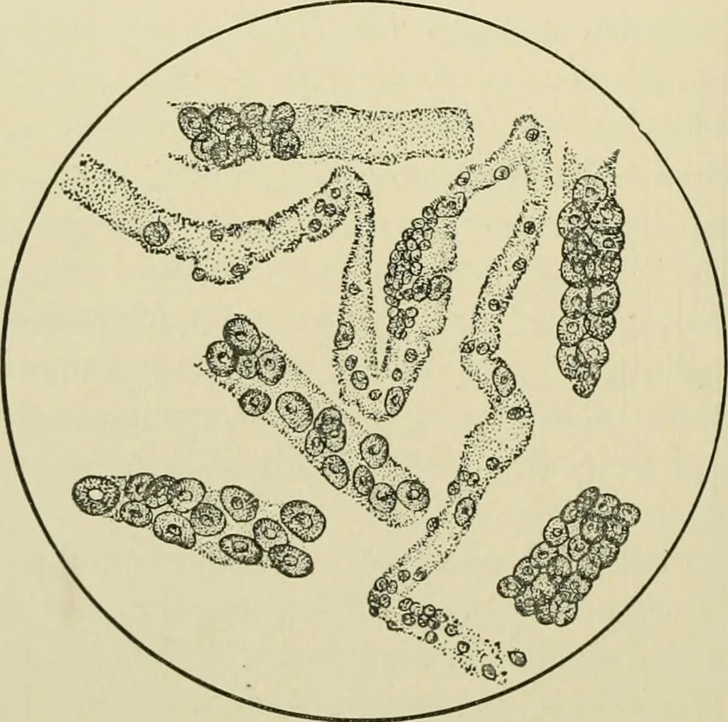 An illustration from Practical diagnosis: the use of symptoms in the diagnosis of disease / By Hobart Amory Hare ... Illustrated with 191 engravings and 13 colored plates., 1896, leaf 390