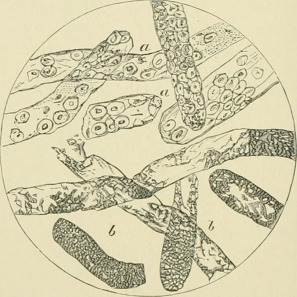 An illustration from Practical diagnosis: the use of symptoms in the diagnosis of disease / By Hobart Amory Hare ... Illustrated with 191 engravings and 13 colored plates., 1896, leaf 392