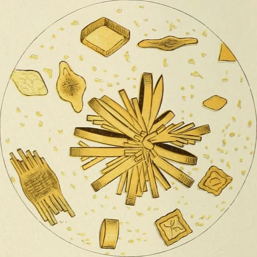 An illustration from Practical diagnosis: the use of symptoms in the diagnosis of disease / By Hobart Amory Hare ... Illustrated with 191 engravings and 13 colored plates., 1896, leaf 394