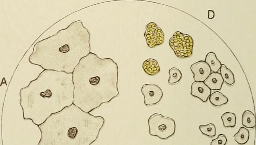 An illustration from Practical diagnosis: the use of symptoms in the diagnosis of disease / By Hobart Amory Hare ... Illustrated with 191 engravings and 13 colored plates., 1896, leaf 394