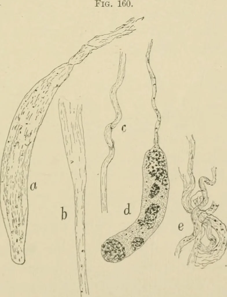 An illustration from Practical diagnosis: the use of symptoms in the diagnosis of disease / By Hobart Amory Hare ... Illustrated with 191 engravings and 13 colored plates., 1896, leaf 395