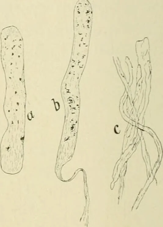 An illustration from Practical diagnosis: the use of symptoms in the diagnosis of disease / By Hobart Amory Hare ... Illustrated with 191 engravings and 13 colored plates., 1896, leaf 396