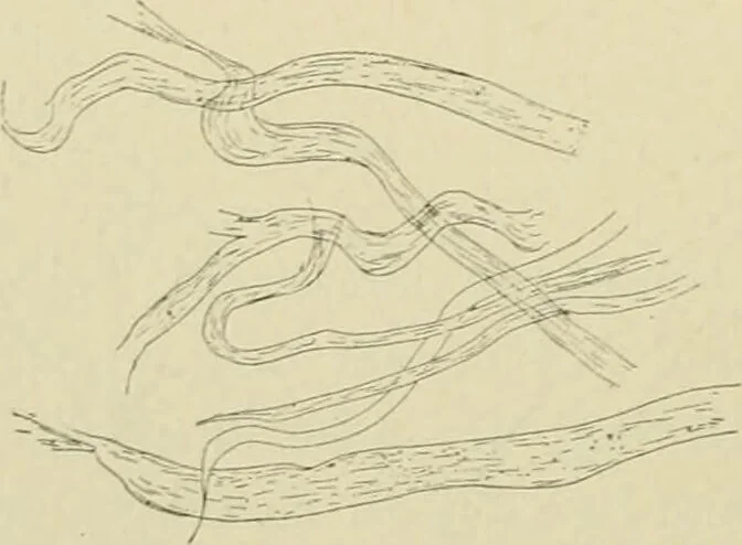 An illustration from Practical diagnosis: the use of symptoms in the diagnosis of disease / By Hobart Amory Hare ... Illustrated with 191 engravings and 13 colored plates., 1896, leaf 396