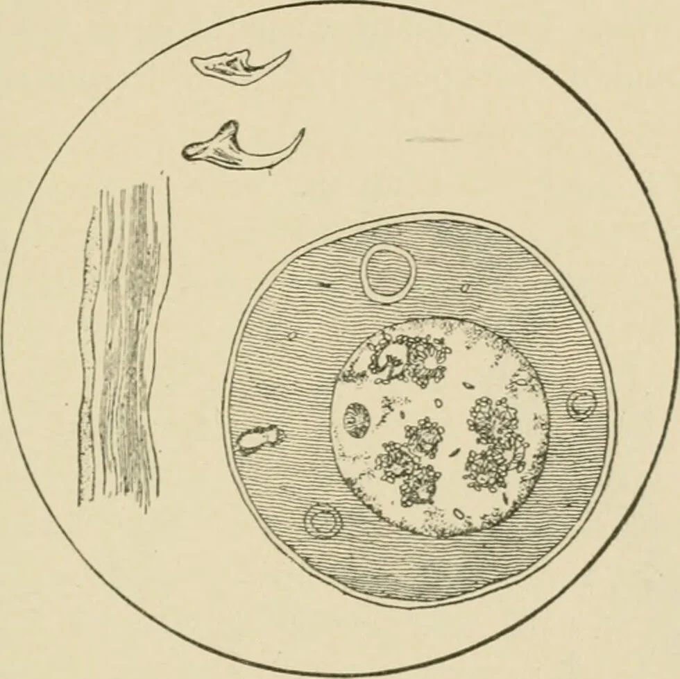 An illustration from Practical diagnosis: the use of symptoms in the diagnosis of disease / By Hobart Amory Hare ... Illustrated with 191 engravings and 13 colored plates., 1896, leaf 401