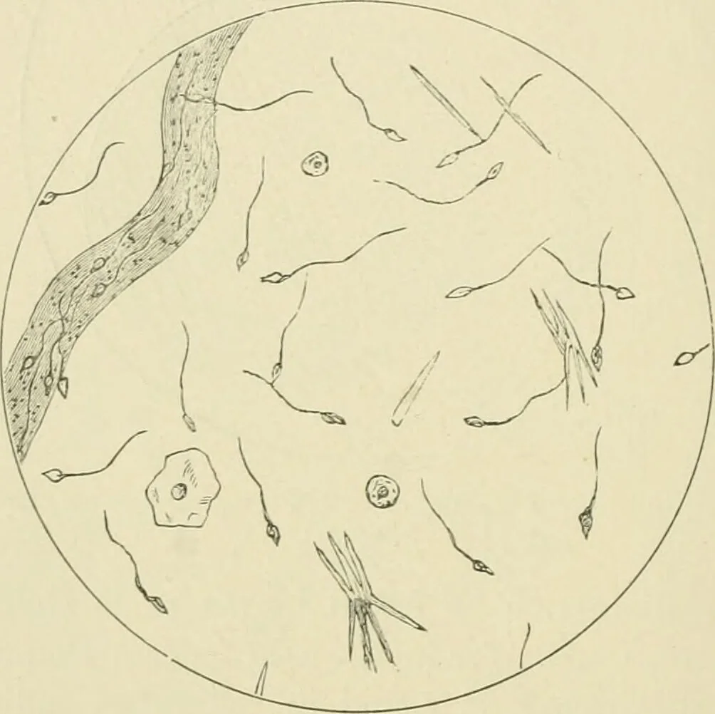 An illustration from Practical diagnosis: the use of symptoms in the diagnosis of disease / By Hobart Amory Hare ... Illustrated with 191 engravings and 13 colored plates., 1896, leaf 402