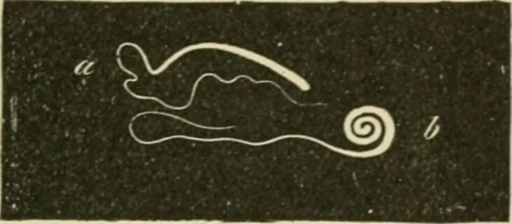 An illustration from Practical diagnosis: the use of symptoms in the diagnosis of disease / By Hobart Amory Hare ... Illustrated with 191 engravings and 13 colored plates., 1896, leaf 431