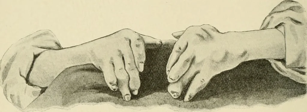 An illustration from Practical diagnosis: the use of symptoms in the diagnosis of disease / By Hobart Amory Hare ... Illustrated with 191 engravings and 13 colored plates., 1896, leaf 50