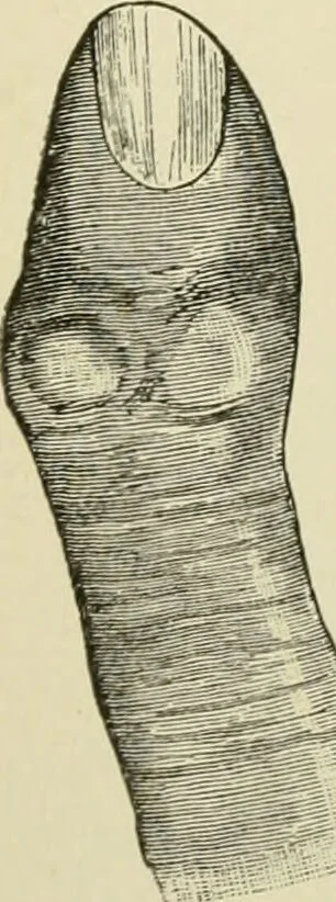 An illustration from Practical diagnosis: the use of symptoms in the diagnosis of disease / By Hobart Amory Hare ... Illustrated with 191 engravings and 13 colored plates., 1896, leaf 50